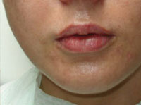 Modelowanie, powiększanie ust Dermatolog