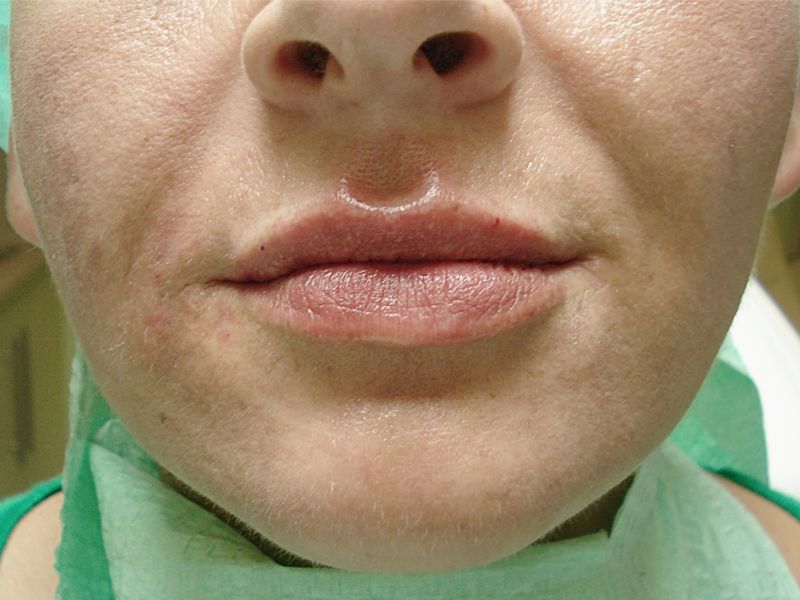 Modelowanie, powiększanie ust Dermatolog